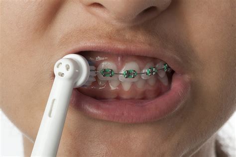 Can I Use an Electric Toothbrush with Braces?